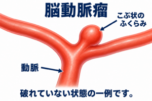 動脈の分かれ目で血管の壁が外側へこぶ状に膨らんだ、未破裂脳動脈瘤の模式図。