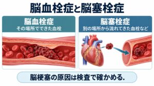 脳血栓症と脳塞栓症を整理した図。