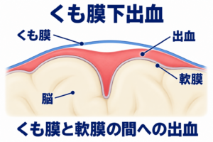 脳の表面に密着する軟膜と、その外側のくも膜の間に出血する位置を示した模式図。