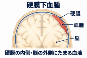 硬膜の内側と脳の外側の間に血腫がたまり、脳を圧迫する位置を示した断面模式図。