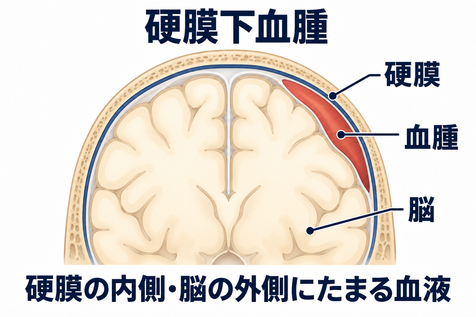 硬膜の内側と脳の外側の間に血腫がたまり、脳を圧迫する位置を示した断面模式図。